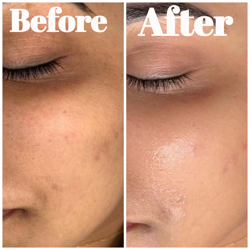 Hinza glow before and after results